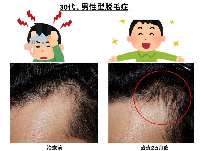 円形脱毛症　病院